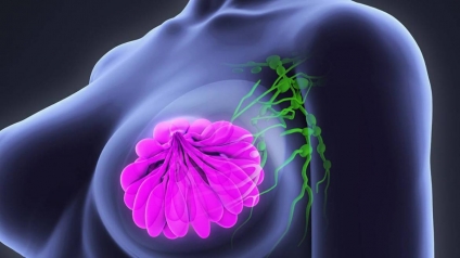 Una droga prolonga más de cuatro años la sobrevida de las personas con cáncer de mama