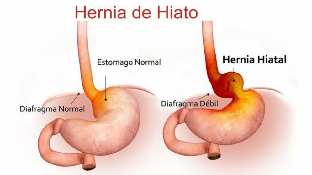 Hernia de Hiato: causas, síntomas y tratamiento