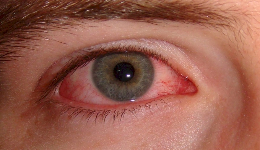 Detectan un nuevo síntoma de la variante Ómicron que se produce en los ojos